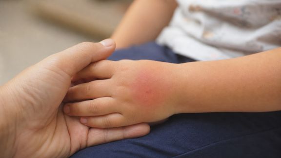 Les bons réflexes face aux piqûres et morsures courantes chez l’enfant